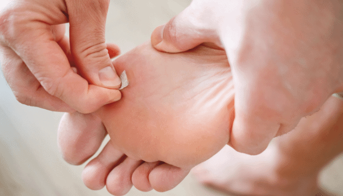 tips on curing a verruca