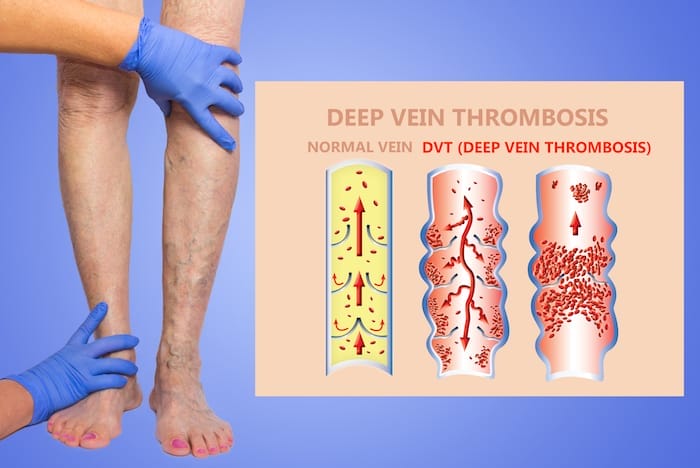 Deep Vein Thrombosis or Blood Clots. Embolus. Structure of normal and varicose female veins