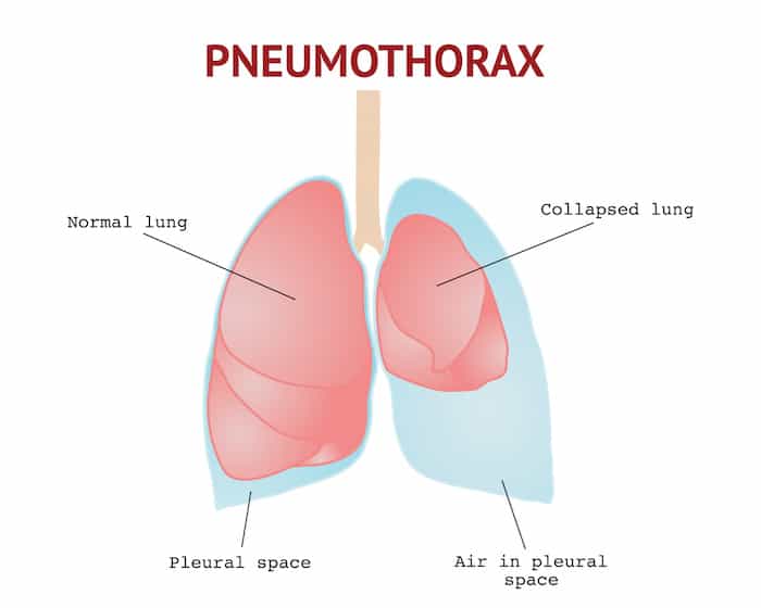 What Causes A Collapsed Lung? 1 AdobeStock 280864101