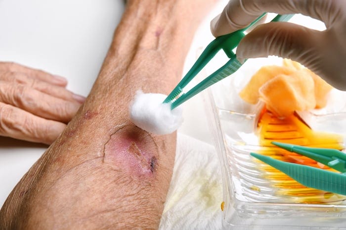 6 Tips For Treating Wounds In The Elderly 1 treating a wound