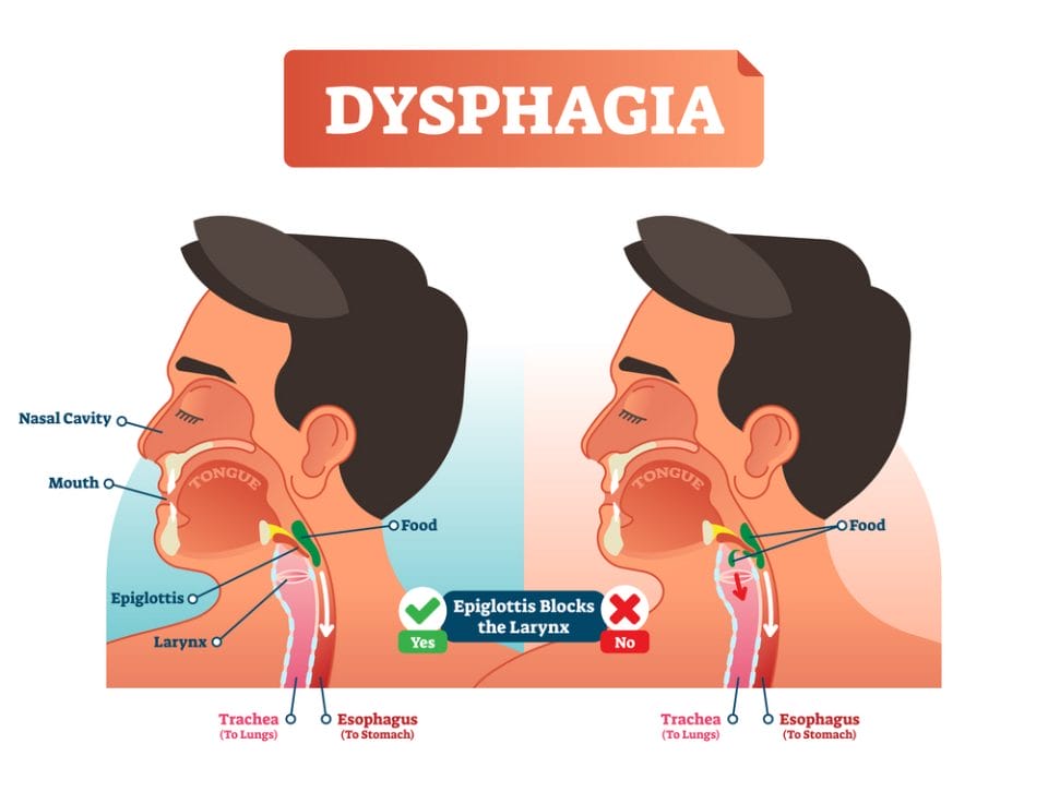 Dysphagia Diagnosis