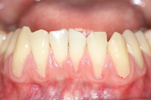 Symptoms of Receding Gums To Look Out For