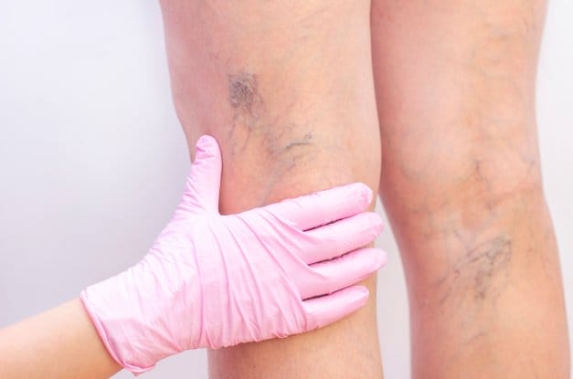 3 Reasons To See a Doctor About Varicose Veins
